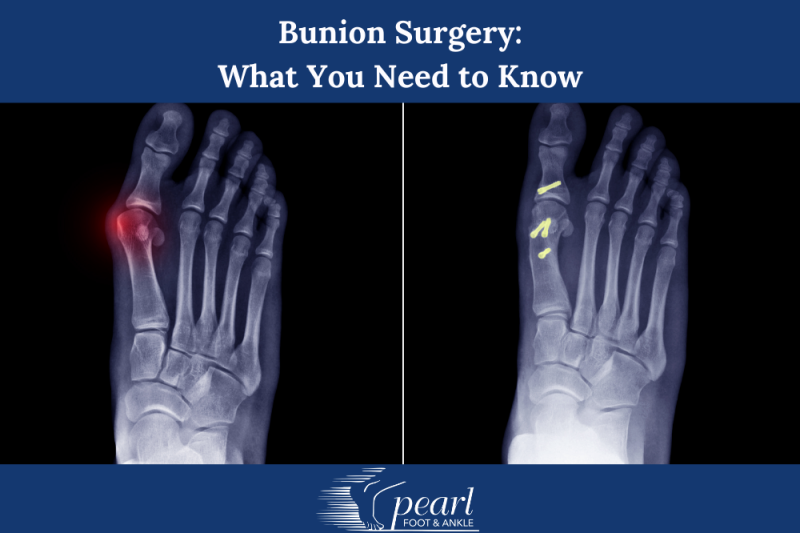 Bunion Surgery What You Need to Know