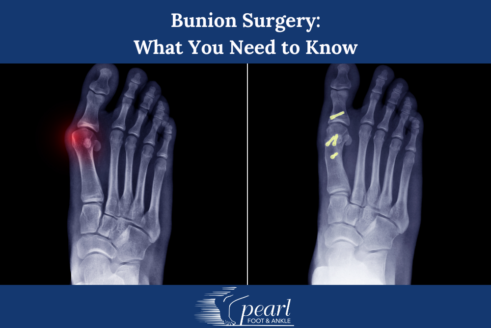Bunion Surgery What You Need to Know